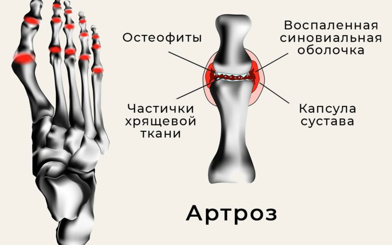 Как болят ноги при остеопорозе?